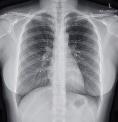 Chest X-ray Of Human Chest or Lung  showing normal lung.