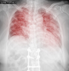 Chest X-ray Of Human Chest or Lung  showing lung  after detect corona virus 2019.