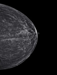  X-ray Digital Mammogram  or mammography at left side of the breast  CC view  for diagnonsis Breast cancer in women isolated on black background.