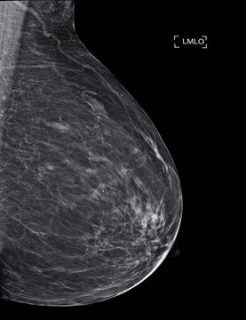  X-ray Digital Mammogram  or mammography at left side of the breast  MLO view  for diagnonsis Breast cancer in women isolated on black background.