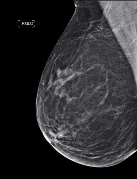  X-ray Digital Mammogram  or mammography at right side of the breast  MLO view  for diagnonsis Breast cancer in women isolated on black background.