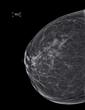  X-ray Digital Mammogram  or mammography  both side of the breast  CC view  for diagnonsis Breast cancer in women isolated on black background.