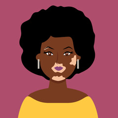 African Woman with Vitiligo on dark skin, Self Love, Vector illustration in Hand Drawn flat style