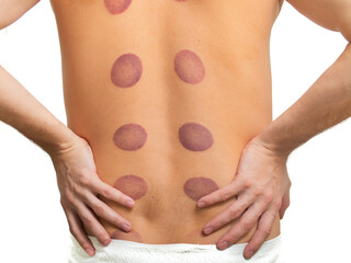 back close-up with traces of treatment jars. Traditional medicine, acupuncture and back massage