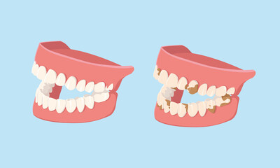 Human jaws isolated on white background. Clean and dirty teeth. Dental model of human jaws. Healthy oral hygiene. Trendy graphic for stomatology, dentist. Vector illustration