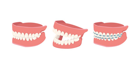 Human Jaw set isolated on white background. Opened, closed jaws and jaws with braces. Dental model of human jaws. Healthy oral hygiene. Trendy graphic for stomatology, dentist. Vector illustration