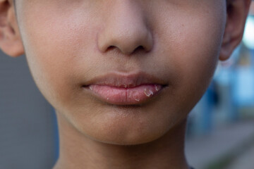 Asian boy is lips skin detachment and cracked due to cold weather in winter and lack of water in the body.