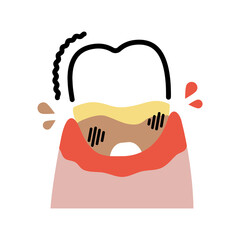 重度の歯周病の歯（1本）