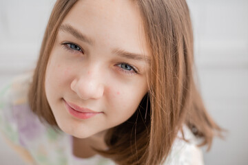 Face of a teenage girl in close up. Teen with problematic skin. Girl with a square hairstyle. Acne and scars. Natural portrait. No makeup and retouch. High quality photo