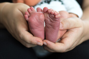 syndaktylie - toe grown togethe on newborn foot