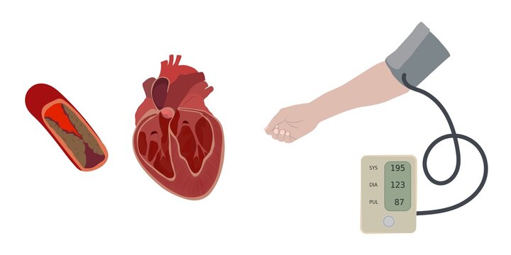 Hypertensive heart disease, illustration