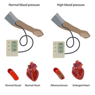 Hypertensive heart disease, illustration