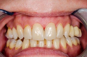 veneers on the middle incisors after inserting