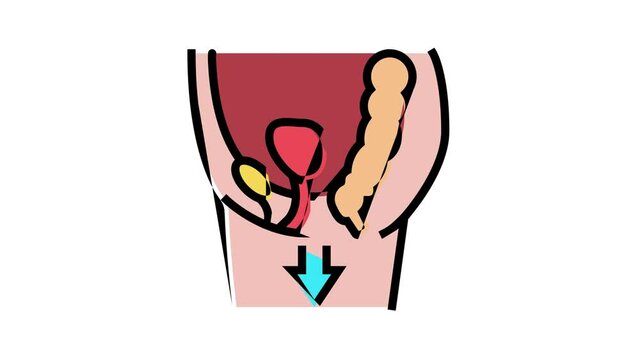 organ prolapse disease animated color icon. organ prolapse disease sign. isolated on white background