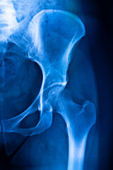 Hips pelvis xray scan