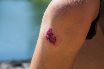 Scraped knee, painful kid knee skin wound.