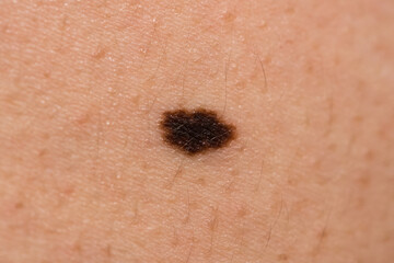 Suspicious mole on skin. Brown birthmark (nevus) on caucasian woman skin