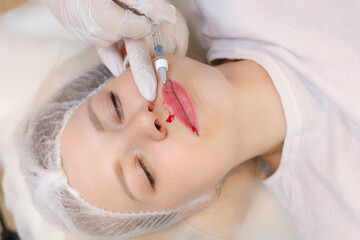 The beautician inserted a needle from the syringe all the way to its base to evenly distribute the hyaluronic acid in the client's lips
