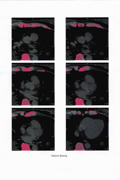 Cardiac CT image report for Calcium Scoring