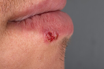 Fototapeta premium herpes in lips is a viral skin disease