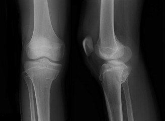 x ray of a tibial plateu fracture