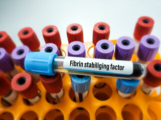 Blood sample for Factor XIII or fibrin stabilizing factor test, diagnosis of coagulation disorder....