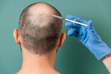 A man with alopecia on his head during a mesotherapy procedure with a trichologist. Back view. Turquoise background. The concept of baldness and professional treatment