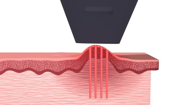 Narbenbehandlung/ Narbenentfernung mit dem Laser