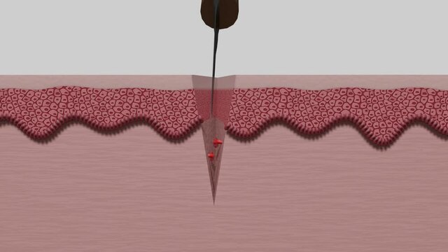 Animation der Wundheilung bzw. Narbenbildung