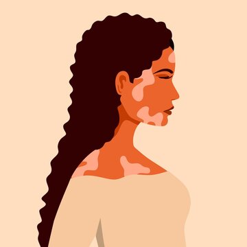 Vitiligo is a young woman with skin problems. Skin diseases. The concept of World Vitiligo Day. Different skin colors of female characters. For a blog, articles, banner, magazine.