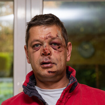Portrait of a man who is injured in the face.