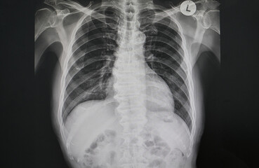 X ray image of patient’s chest