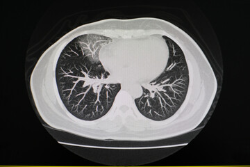 CT scan (computed tomography) of chest organs.