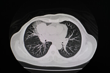 CT scan (computed tomography) of chest organs.