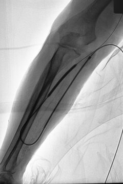 x ray imgae perform balloon catheter inflation in ulnar artery.