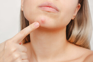 Cropped shot of a young woman pointing to a red inflamed pimple on her chin on a white background....