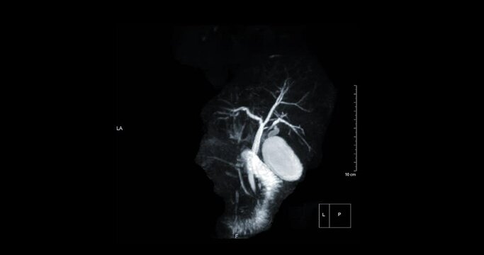 Magnetic resonance cholangiopancreatography or MRCP 3D MIP image to visualize the biliary and pancreatic ducts .