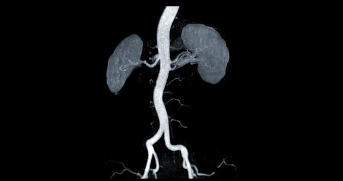 MRA Renal Artery Turn Around On Black Background.