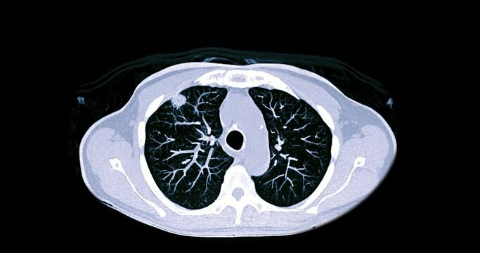 CT Chest or CT Lung axial mip view for diagnostic lung diseases and covid-19.