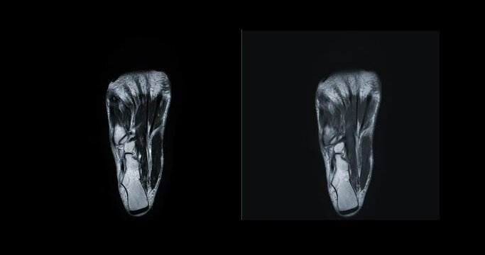 MRI FOOT Coronal T1W  for diagnostic tendon of foot injury.