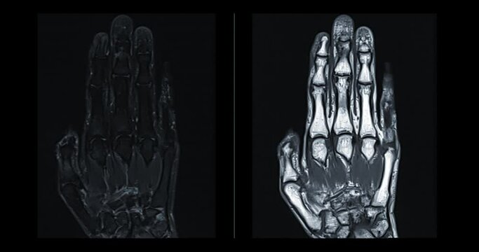 MRI hand coronal PDW  and stir fat suppression for diagnosis bone arthritis and rheumatoid.