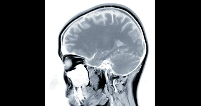 MRI Brain Sagittal plane  on white background.