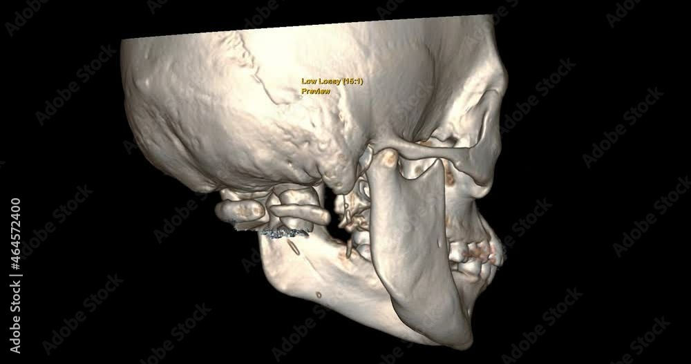 Poster ct scan of skull or facial bone in patient trauma case 3d rendering image rotating on the screen . m