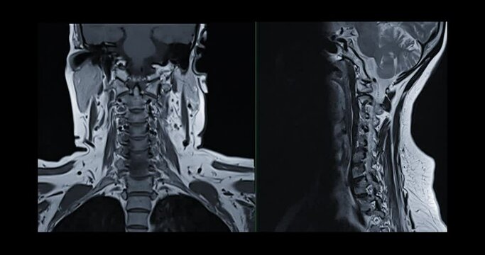  MRI C-spine or magnetic resonance image of cervical spine Axial , Coronal and sagittal plane showing spondylosis  and compression fracture.