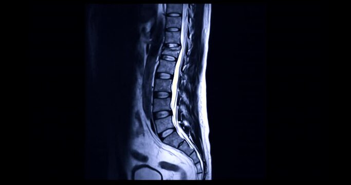 MRI L-S spine or lumbar spine on sagittal plane for diagnosis spinal cord compression.