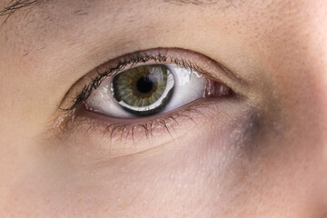 Obraz premium An open green eye with a slight redness of the vessels and a slight bruise on the skin.