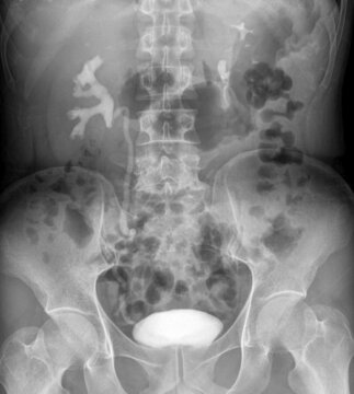 x ray image of intravenous pyelography