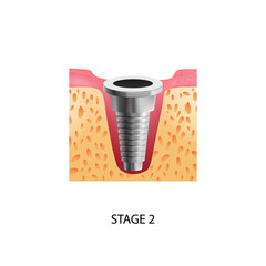 Implantation Second Stage Composition