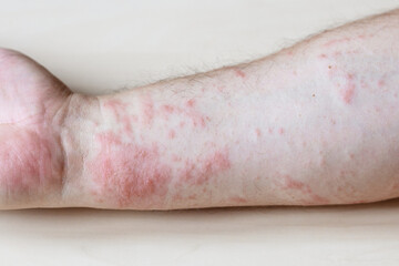 sample of Allergic contact dermatitis - itchy rash on side of forearm close up - obrazy, fototapety, plakaty