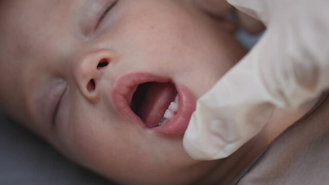 doctor dentist hands fingers in white gloves check sleeping caucasian baby infant first upper and low milk teeth eruption. kid child teething in swollen gums dentition in mouth